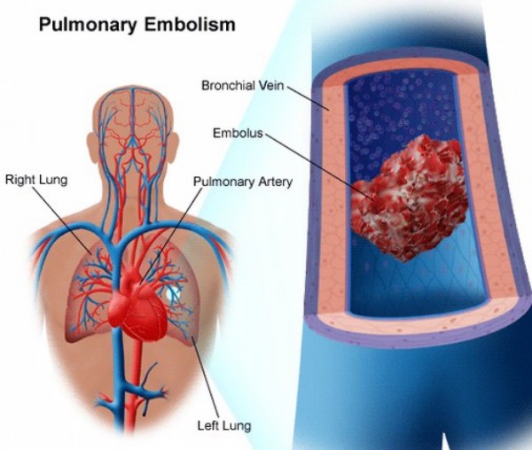 Najnovije preporuke u lečenju tromboembolije pluća