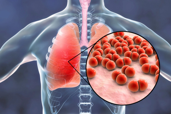 Pneumokokna bolest – teret obolevanja, izazovi u lečenju i značaj prevencije