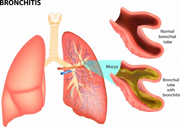 Mukolitici u terapiji hronicnog bronhitisa
