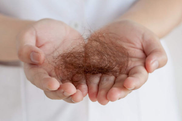 Alopecija